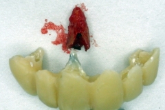 治療中の仮歯は危険